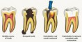 /album/fotogaleria-endodoncia/images3k7n2ne8-jpg/